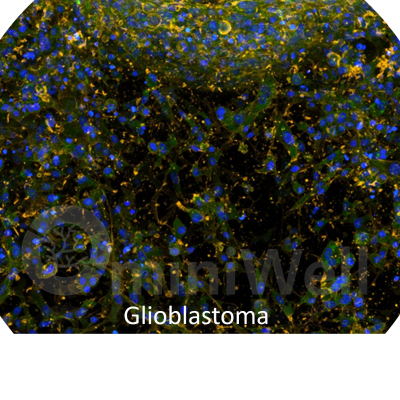 Glioblastoma